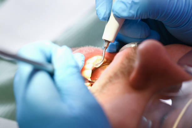 Best Knocked-Out Tooth (Avulsed Tooth) Treatment in Kualapuu, HI